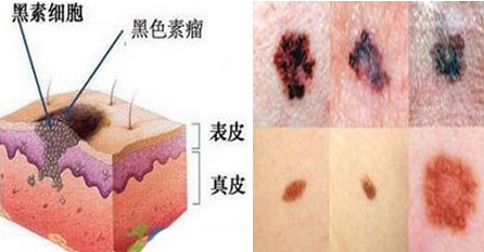 2,形状不规则,快速增大的黑痣:对于一些发育异常的黑痣,比如